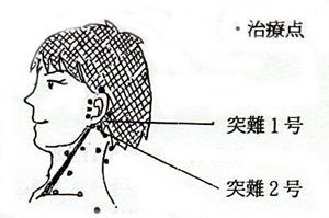 突発性難聴の治療点(ツボ・経穴)
